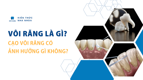 Vôi răng là gì? Cạo vôi răng có ảnh hưởng gì không?